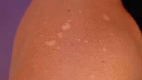 Formulaciones de crema loción y lacas antifungicas (onicomicosis, pitiriasis versicolor, micosis cutáneas)