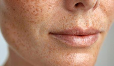 Formulaciones de cremas antiqueratosas (psoriasis, hiperqueratosis, seborrea)