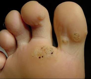 Formulación de solución queratolíticas verrucidas (verrugas, mezquinos, molusco, callos)