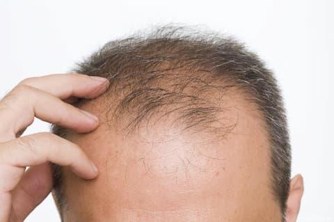 Formulación para alopecia